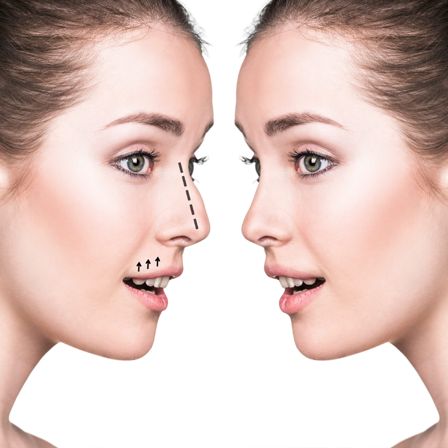 Nose Rhinoplasty Masterclass Video